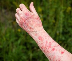 Fotodermatoza – co to jest? Objawy i leczenie