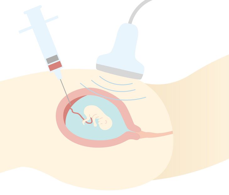 Biopsja kosmówki to jedno z badań wykonywanych w ramach diagnostyki prenatalnej. /Fot. Adobe Stock