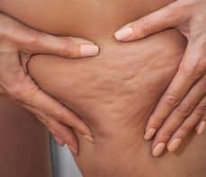 Cellulit wodny – jak się go pozbyć? Sprawdzone sposoby