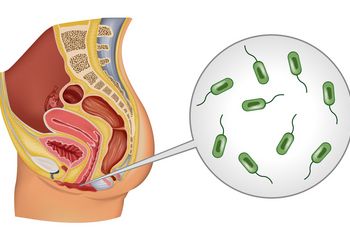 Waginoza bakteryjna (WB) to powszechne schorzenie ginekologiczne spowodowane zachwianą równowagą mikroflory bakteryjnej pochwy - przede wszystkim nadmiernym rozwojem bakterii beztlenowych.