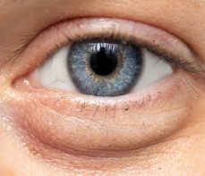 Worki pod oczami – przyczyny. Jak się pozbyć worków pod oczami? Domowe sposoby i sprawdzone kremy