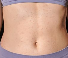 Wysypka na brzuchu to nie tylko przejaw alergii