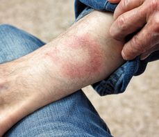 Rumień wędrujący to objaw boreliozy. Jak go odróżnić od reakcji alergicznej?