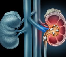 Kamica nerkowa – przyczyny, rodzaje, diagnostyka i leczenie