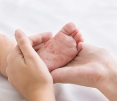 Różyczka – objawy u dzieci i dorosłych. Czy szczepionka przeciwko różyczce jest skuteczna?