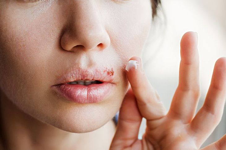 Opryszczka Na Ustach Przyczyny Fazy I Leczenie Ile Trwa Opryszczka Wargowa Apteline Pl
