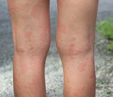 Pokrzywka alergiczna – przyczyny, objawy i leczenie