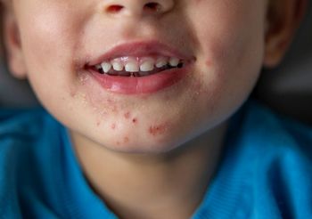 Objawy bostonki (krostki, grudki, bąble, wysypka) widoczne na skórze dziecka wokół ust