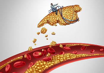 blaszka miażdżycowa oderwana od naczynia krwionośnego