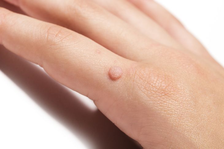Kurzajka na dłoni wywołana przez wirus HPV. 
