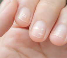 Białe plamki na paznokciach — o czym świadczą i czy jest się czym martwić?